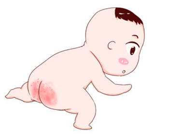 新生儿红屁股的处理方法,新生儿红屁股破了怎么处理