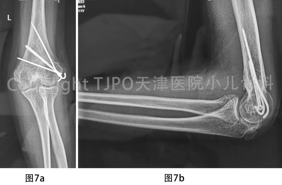 肱骨髁上骨折如何预防肘外翻畸形,肱骨髁上骨折外翻畸形原因