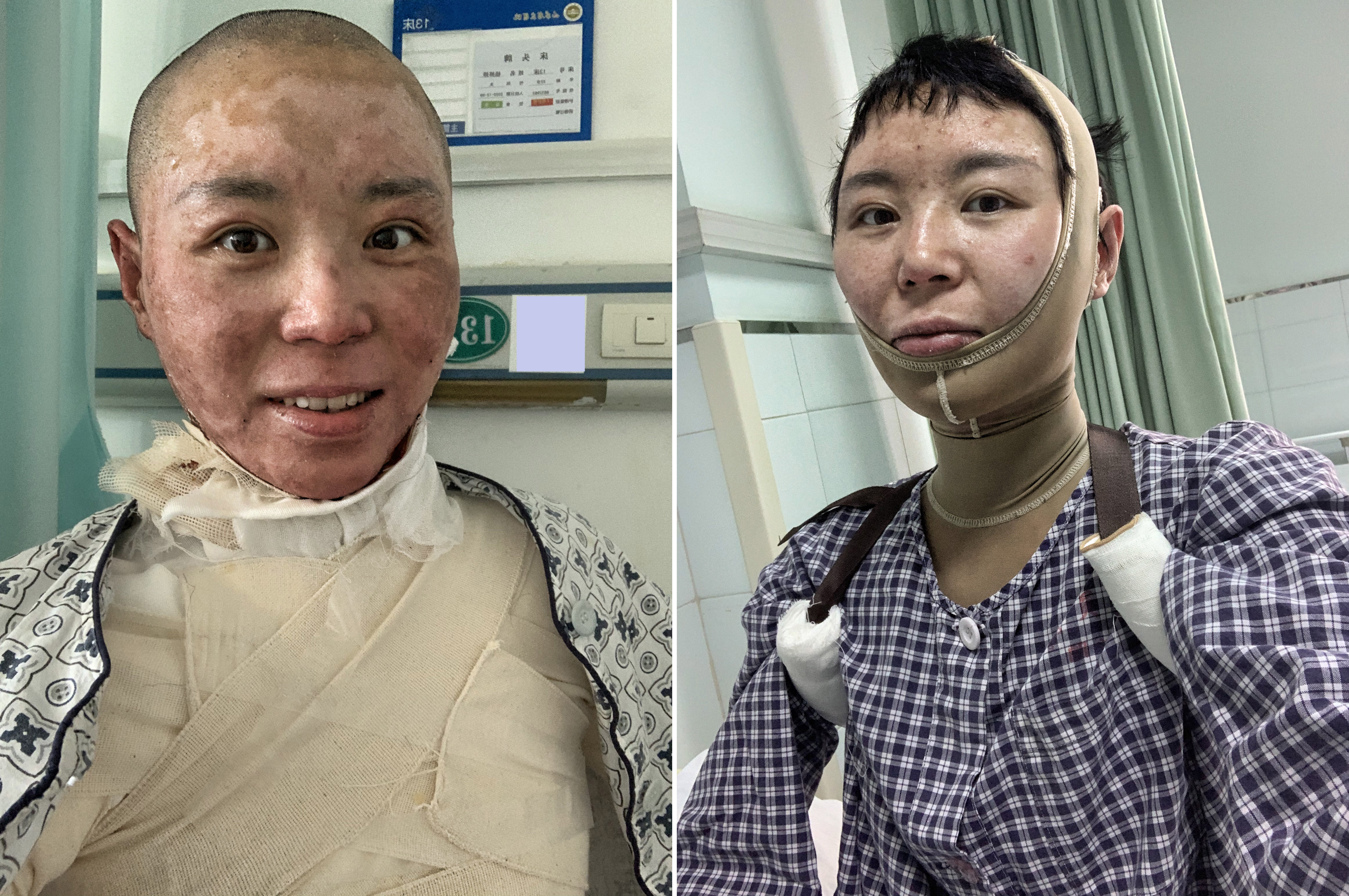 美女辣妈拔火罐烧伤如戴紧箍咒,美妈凌晨拔火罐烧伤