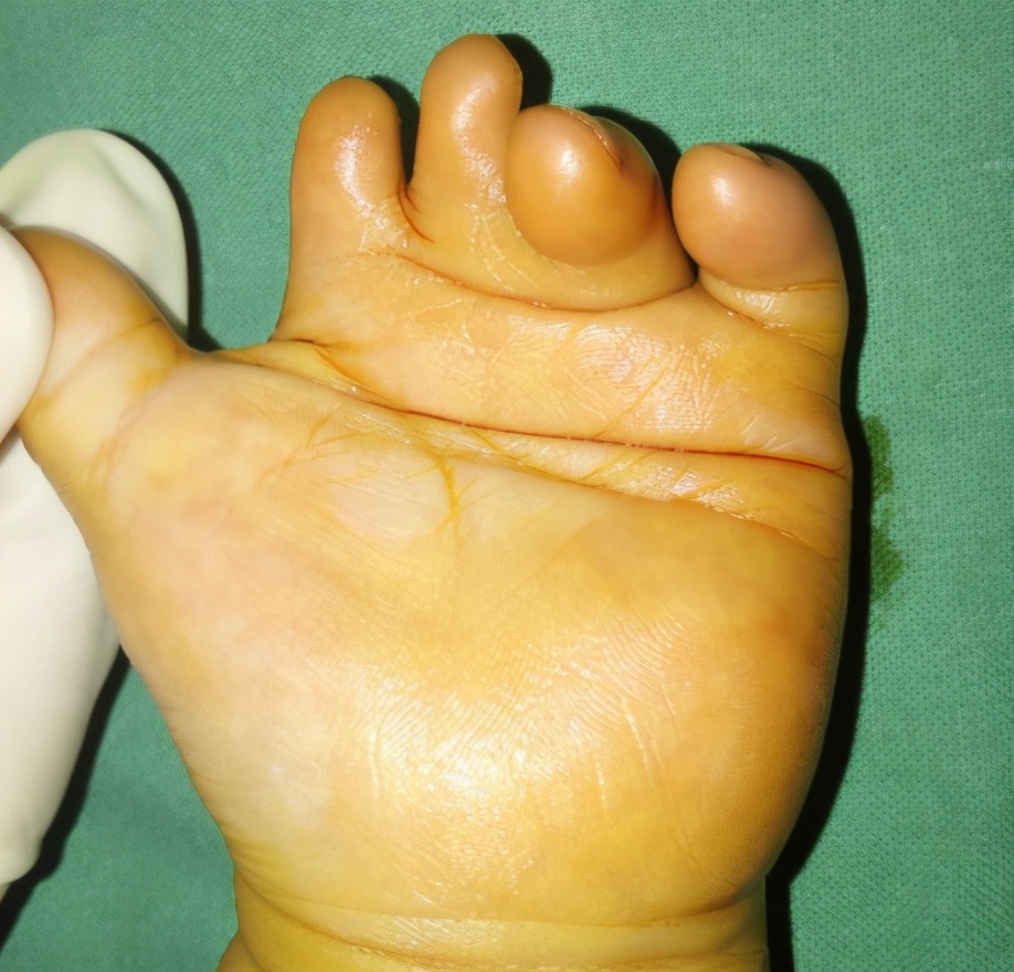 并指畸形免植皮案例,并指畸形