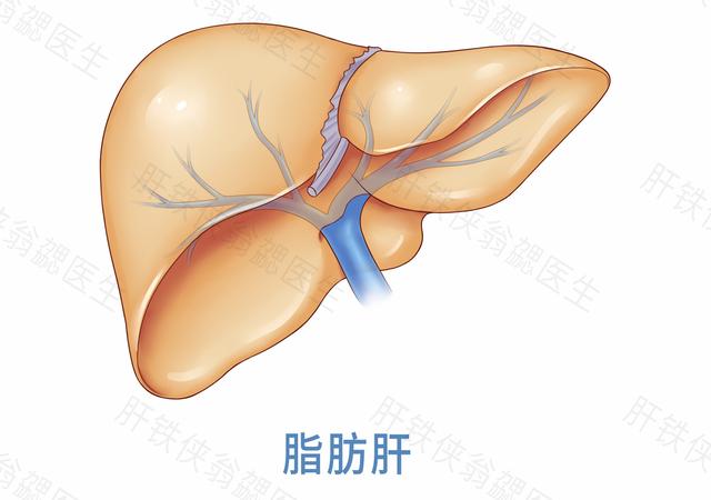 为什么胖子容易得脂肪肝,为什么有些胖子没有脂肪肝