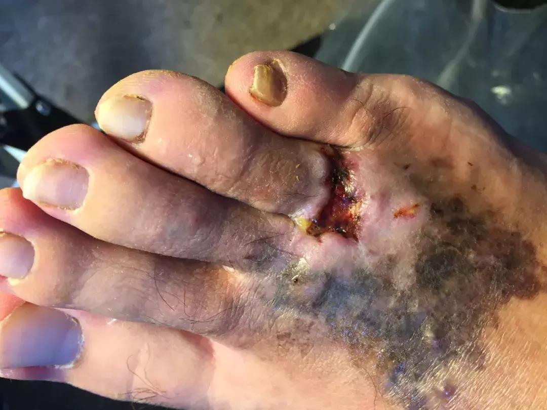 中国留学生被截肢,励志留学生