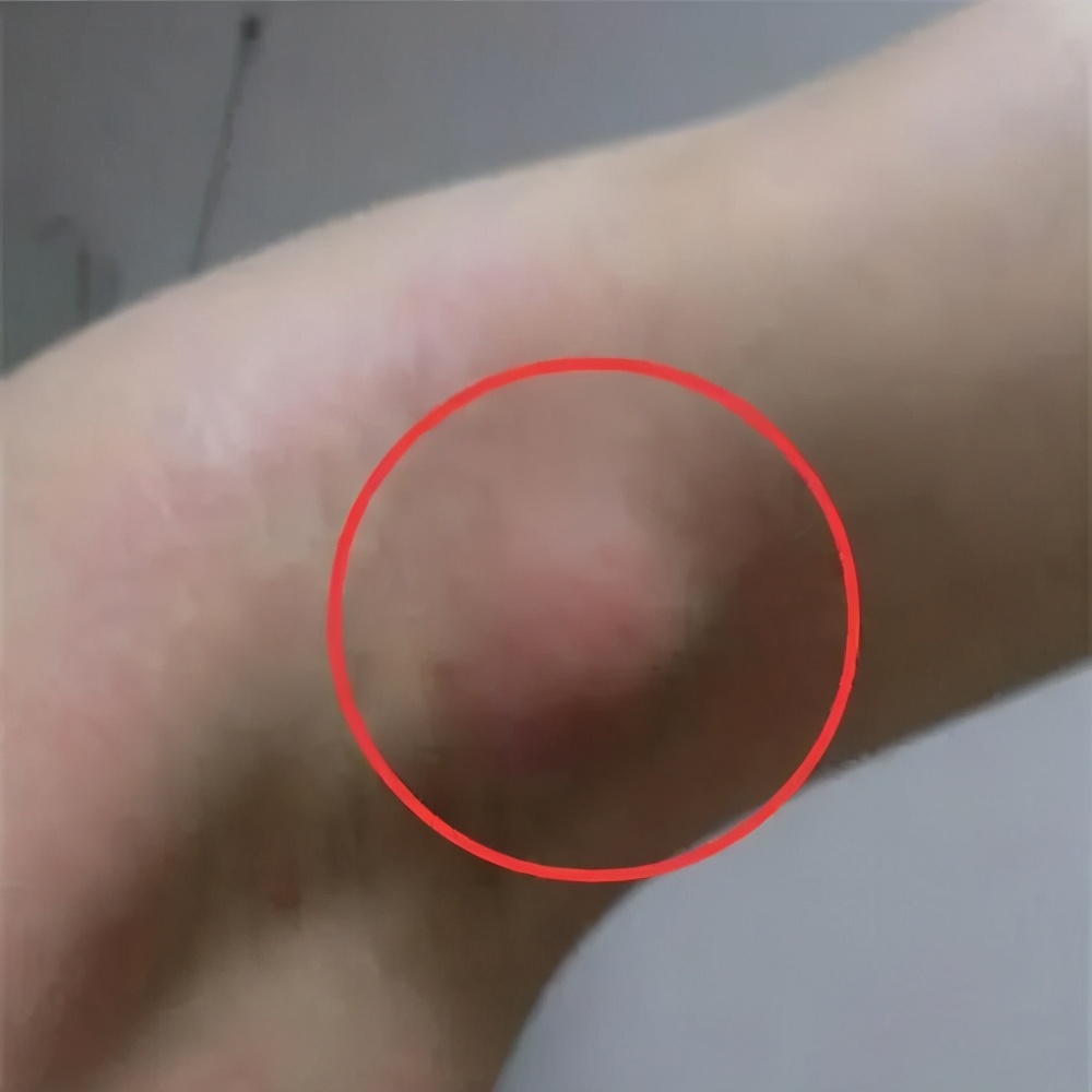 为什么身体起疙瘩一样的包,身体到处都是密密麻麻的包怎么办