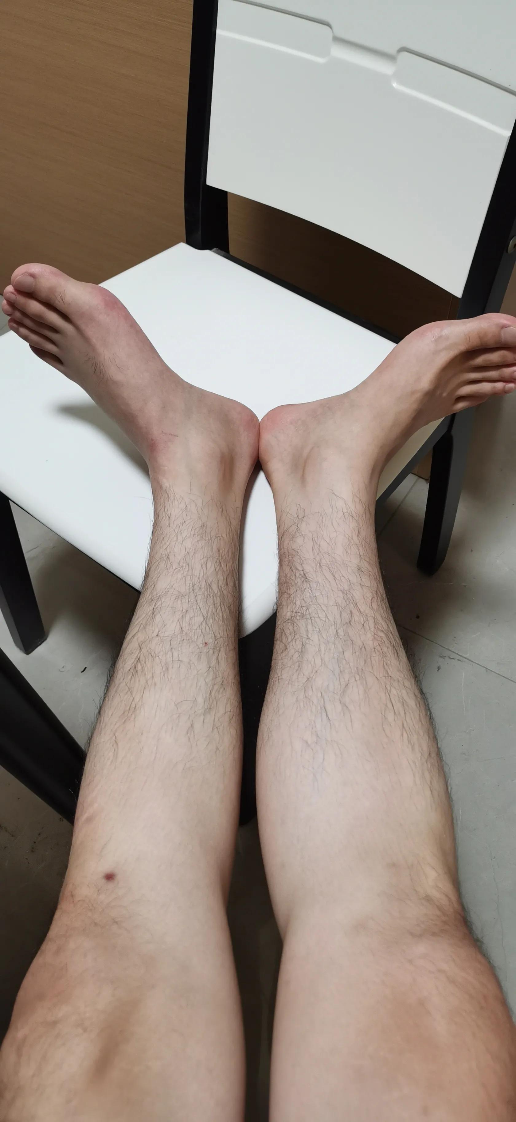 第五跖骨基底部骨折60天能走路吗,第五跖骨基底部骨折60天能脱拐吗