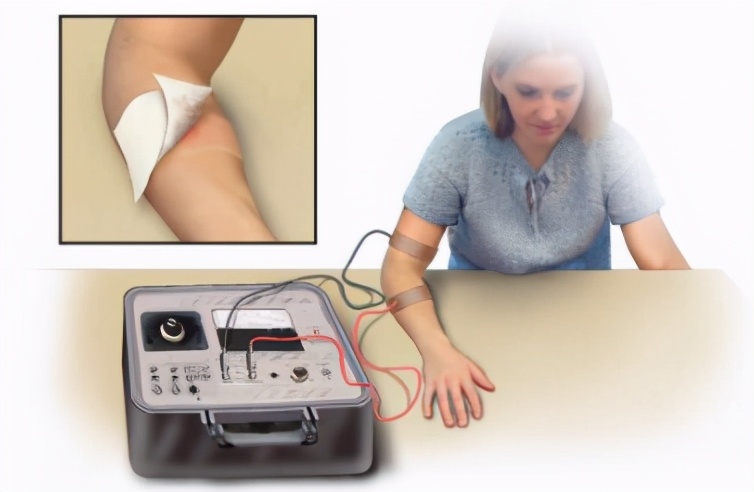 支气管扩张会导致杵状指吗,支气管扩张有杵状指吗