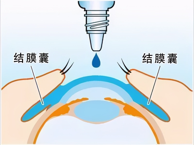 「掌健识」世界青光眼周：青光眼药物治疗之你问我答