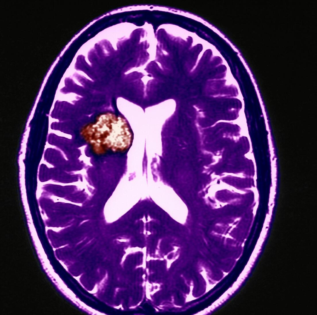 28岁男子排便太用力致脑出血,男人排便出血什么原因