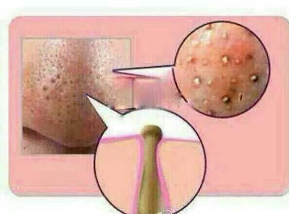 去黑头最有效最简单的方法,最简单有效的去黑头的方法