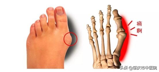 原来脚拇趾外翻是一种病，“元凶”竟是经常穿这种鞋有关！听听市中医院骨伤科专家怎么说……