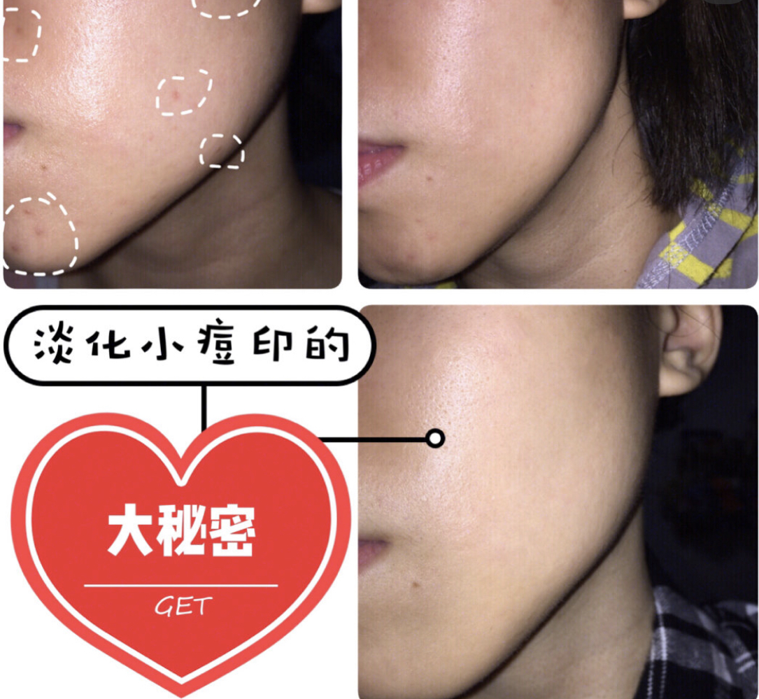 痘印小疙瘩用什么遮,祛痘霜修复痘疤淡化痘印用什么
