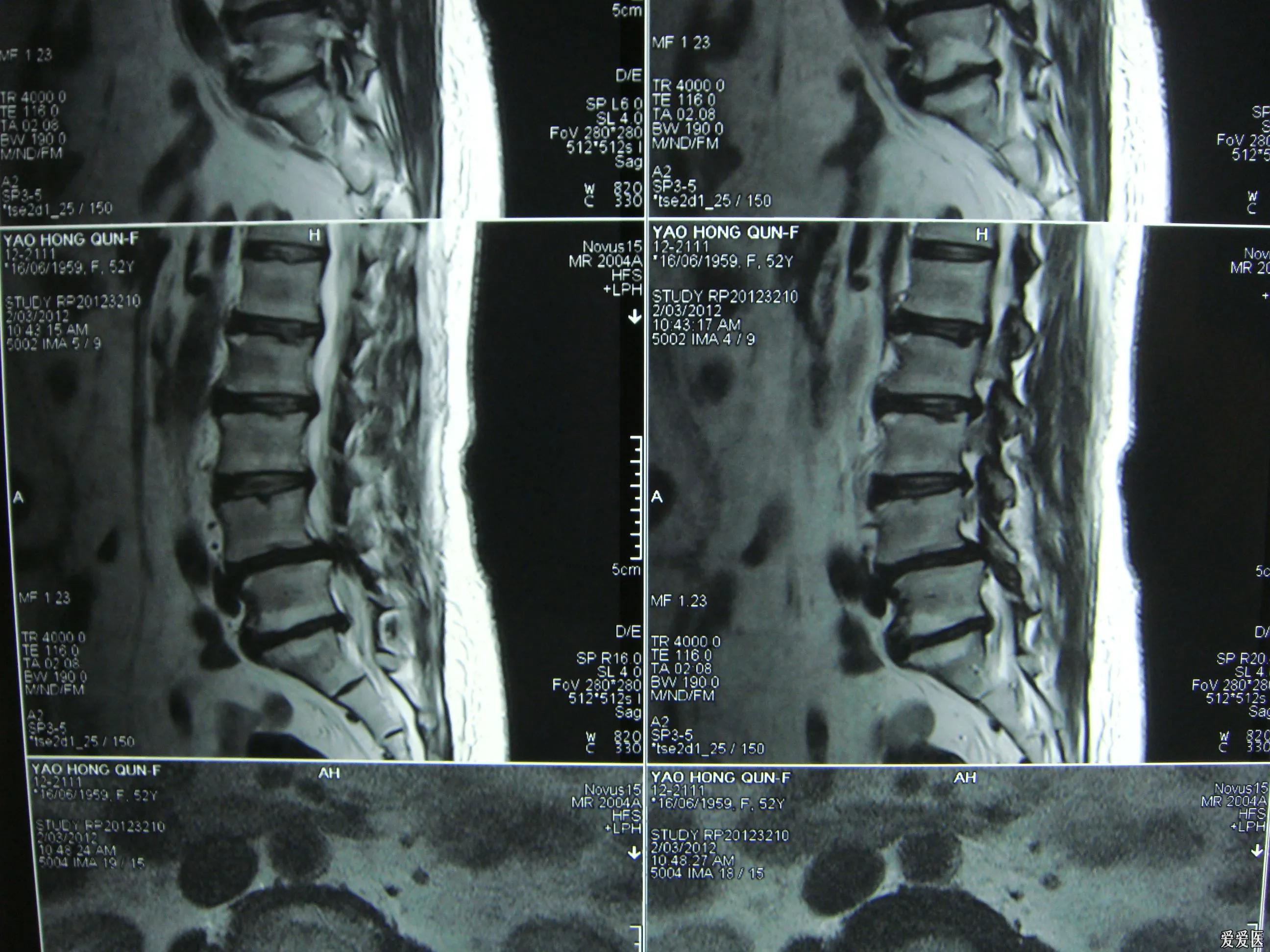 25岁得了腰椎间盘突出4年了,50岁腰椎间盘突出腰疼