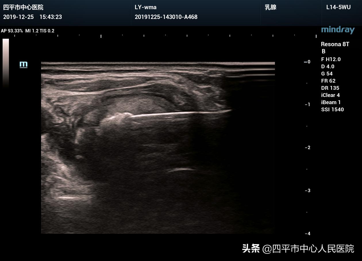 超声引导下甲状腺结节微波消融术,甲状腺结节微波消融术哪有做的