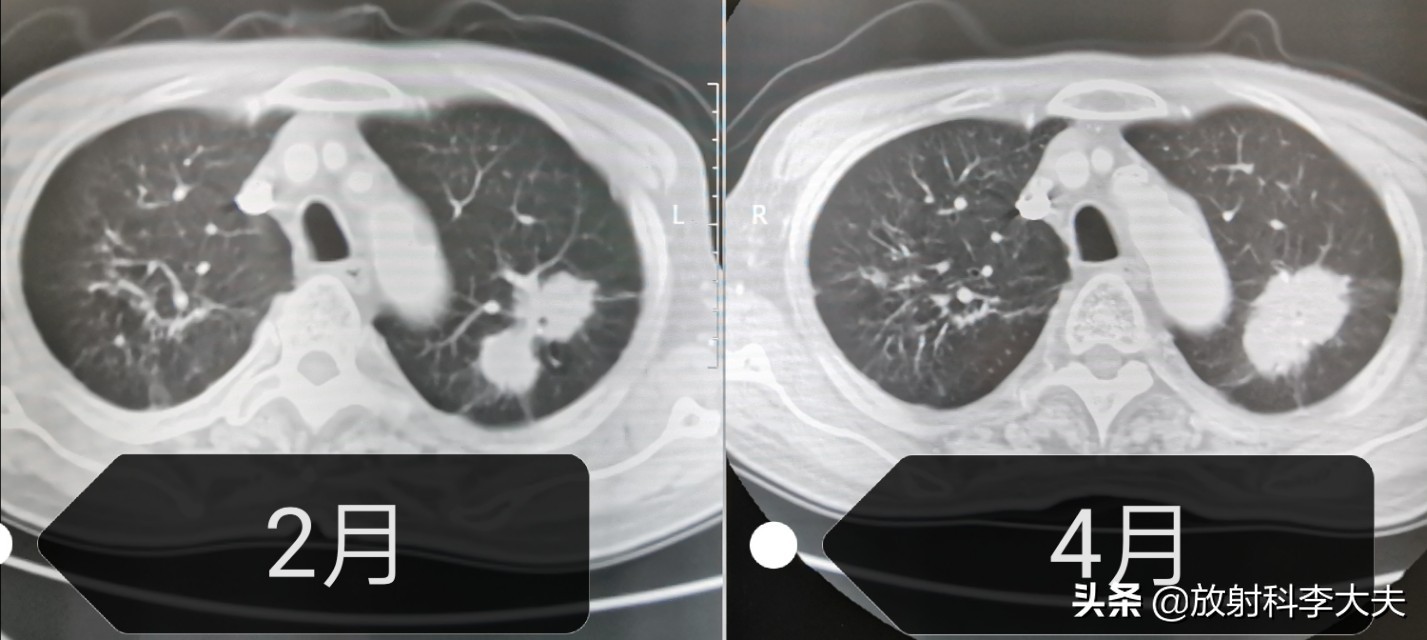 几年前得过肺结核现在胸透有阴影,结核治疗一年了还有胸痛