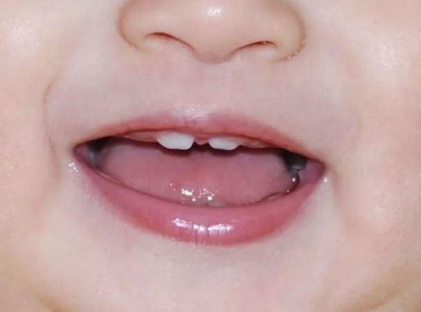 小孩牙缝太大需要看牙医吗,7岁小孩牙缝大了还能长吗