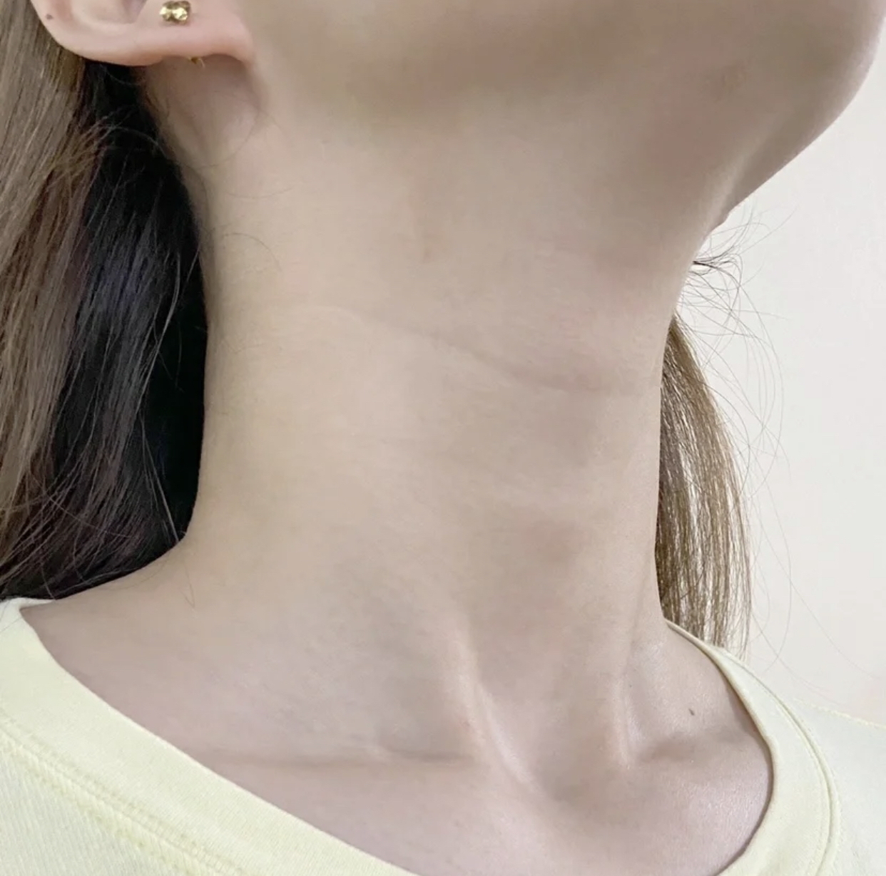 颈纹很深做什么运动,有很深颈纹的女生怎么改善