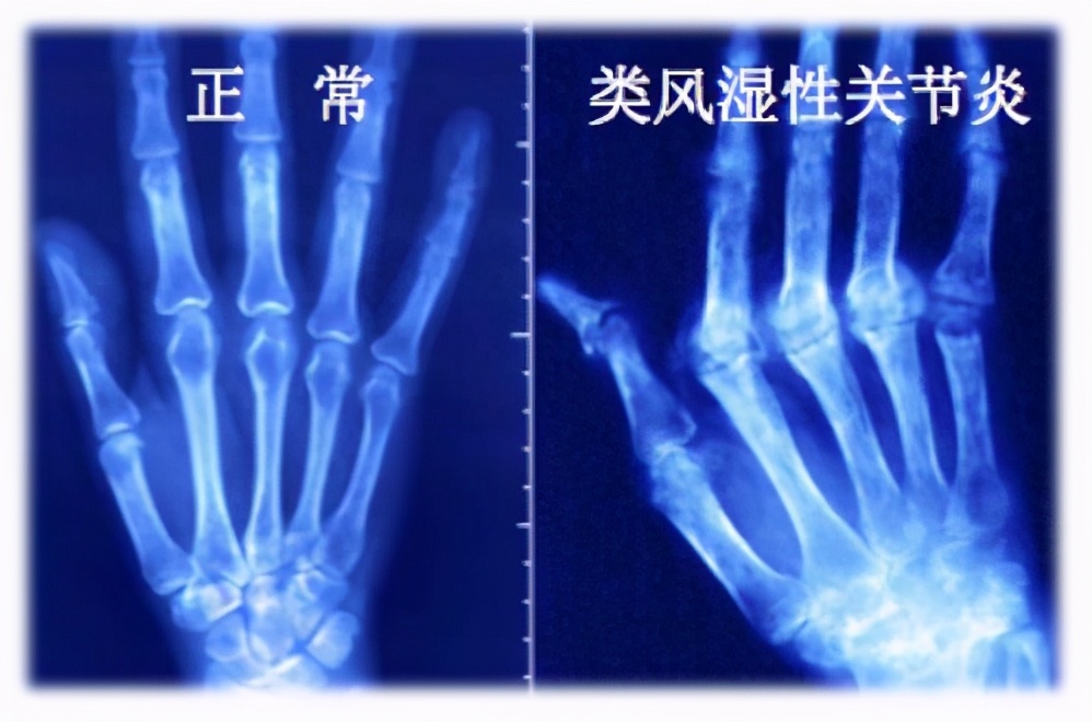 “东方美女”也是病？严重能夺命