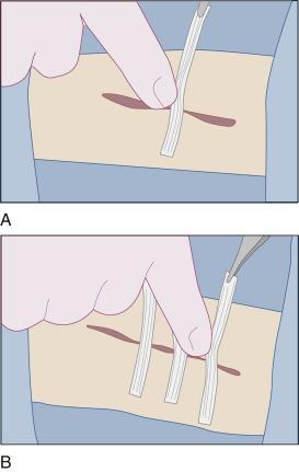 手割破了用创可贴吗,割破了手该如何处理