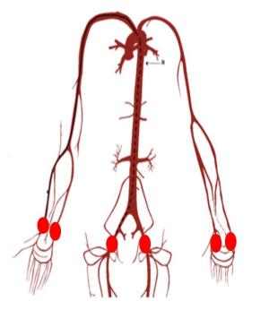 无保护单臂大回环,无保护左主干