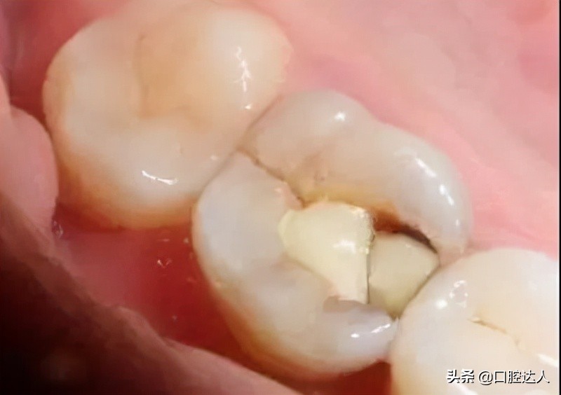 做根管的牙齿掉了一小块怎么办,门牙牙齿根部掉了一小块有凹洞