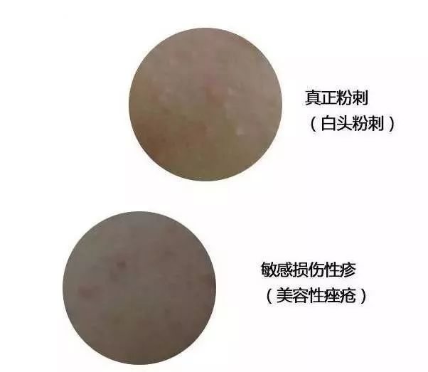 闭合性粉刺的正确消除方法,阿司匹林祛除闭合性粉刺