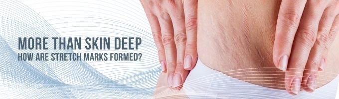 如何避免出现妊娠纹这5步要做好,怎么预防妊娠纹的发生