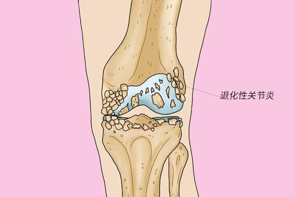 膝盖弯曲经常有响声是缺钙吗,走路多膝盖疼是缺钙吗