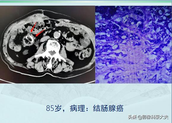 关于便秘的一些事儿,来聊聊便秘