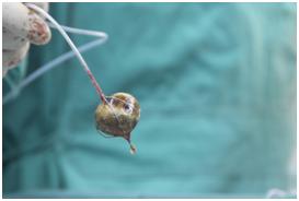 治胆结石是个小手术吗,胆结石是保胆好还是摘除好