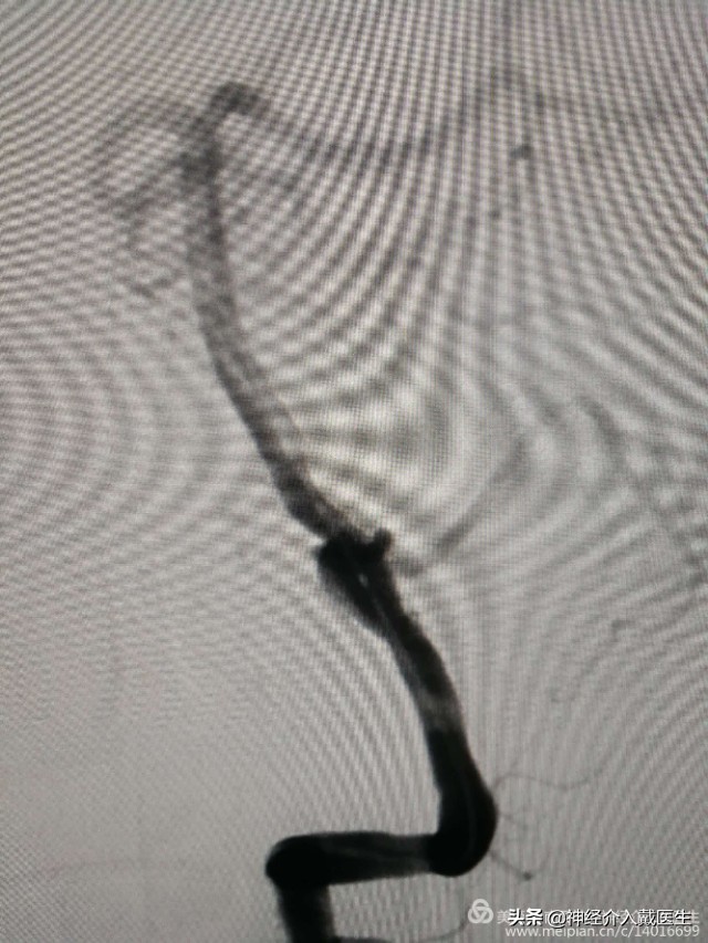神经外科手术动脉瘤,湖南省人民医院脑动脉瘤介入治疗
