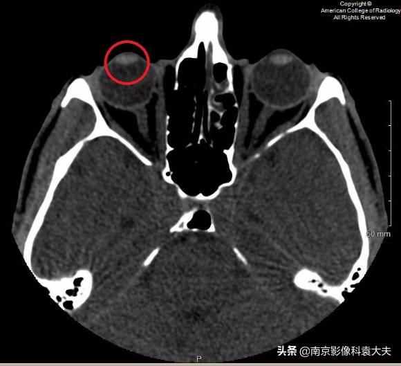 一39岁男子争吵后，右眼突然瞎了，病例分析知答案