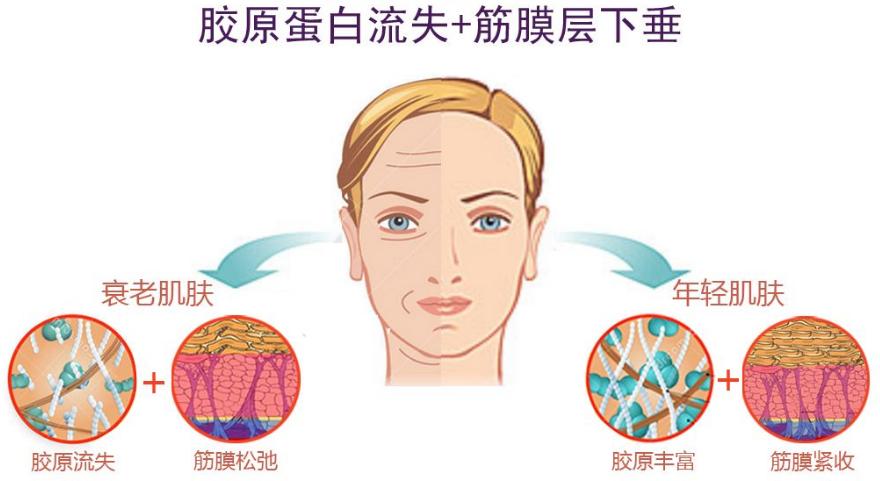 面部抗衰老有哪些项目,面部抗衰老有哪些整形项目