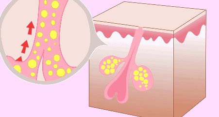 易出油皮肤怎么改善,混干皮t区出油怎么化妆