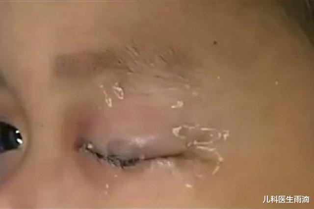 儿子误将502滴入眼中,亲爸“教科书”式施救,连医生都夸赞