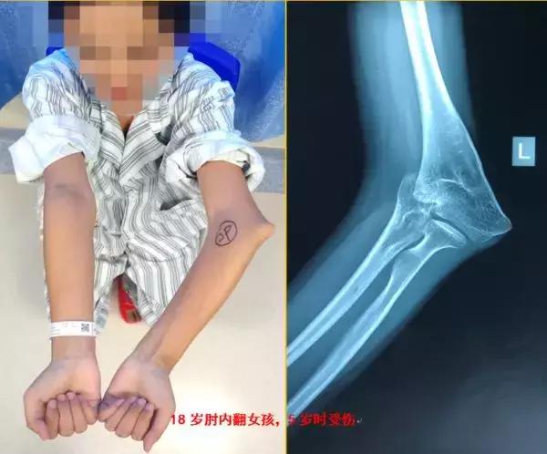 人的胳膊肘都是往里拐的,胳膊肘往里拐是什么原因