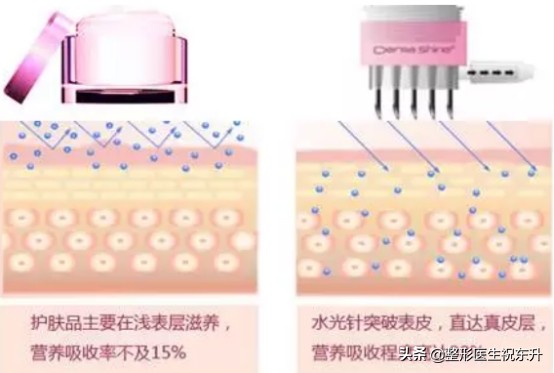 水光针面膜真的有用吗,打水光针为什么要面膜