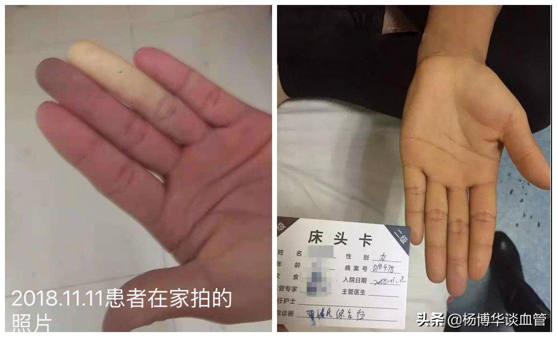 手指发白一定是雷诺症吗,雷诺氏病手指脱皮是好转现象吗