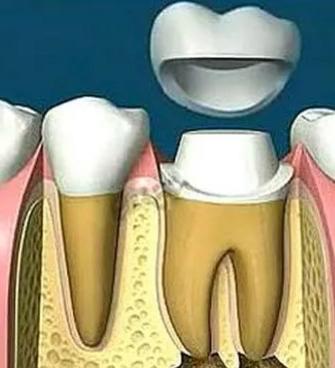 根管治疗为什么要做冠部修复,做完根管治疗以后不补会怎么样