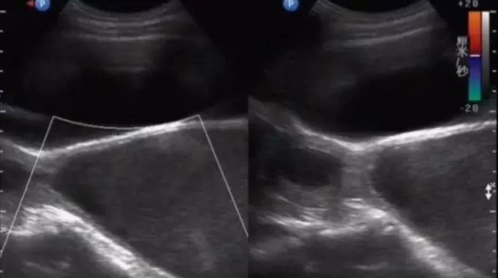 处女的第一次都会流血吗?会不会有例外?一次性科普到位