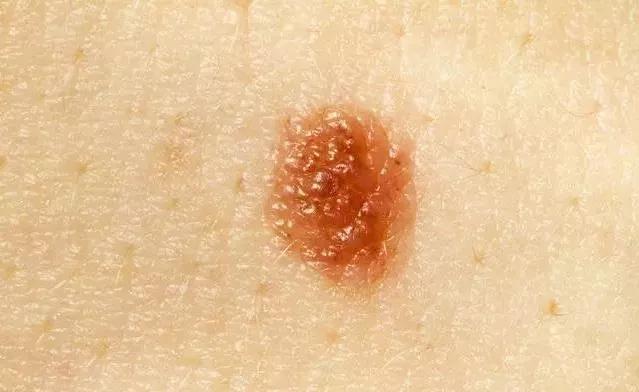 身上有小红痣有时还痒是怎么回事,老年人身上长小红痣是什么原因