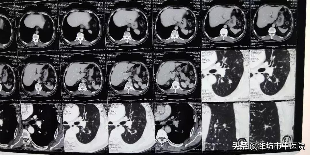 肺癌晚期肝转移肾转移能活多久,肺癌晚期肾转移有哪些表现