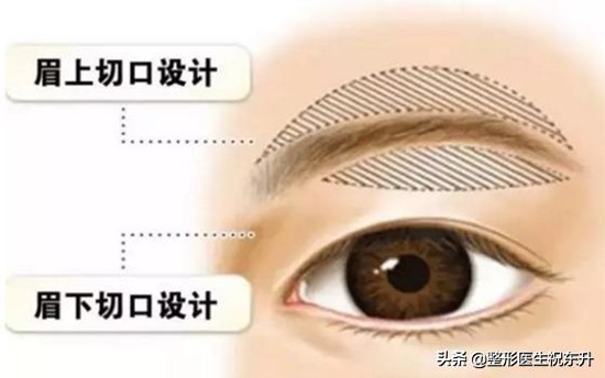 与大家聊一聊的技巧,做提眉手术后应该注意哪些事项