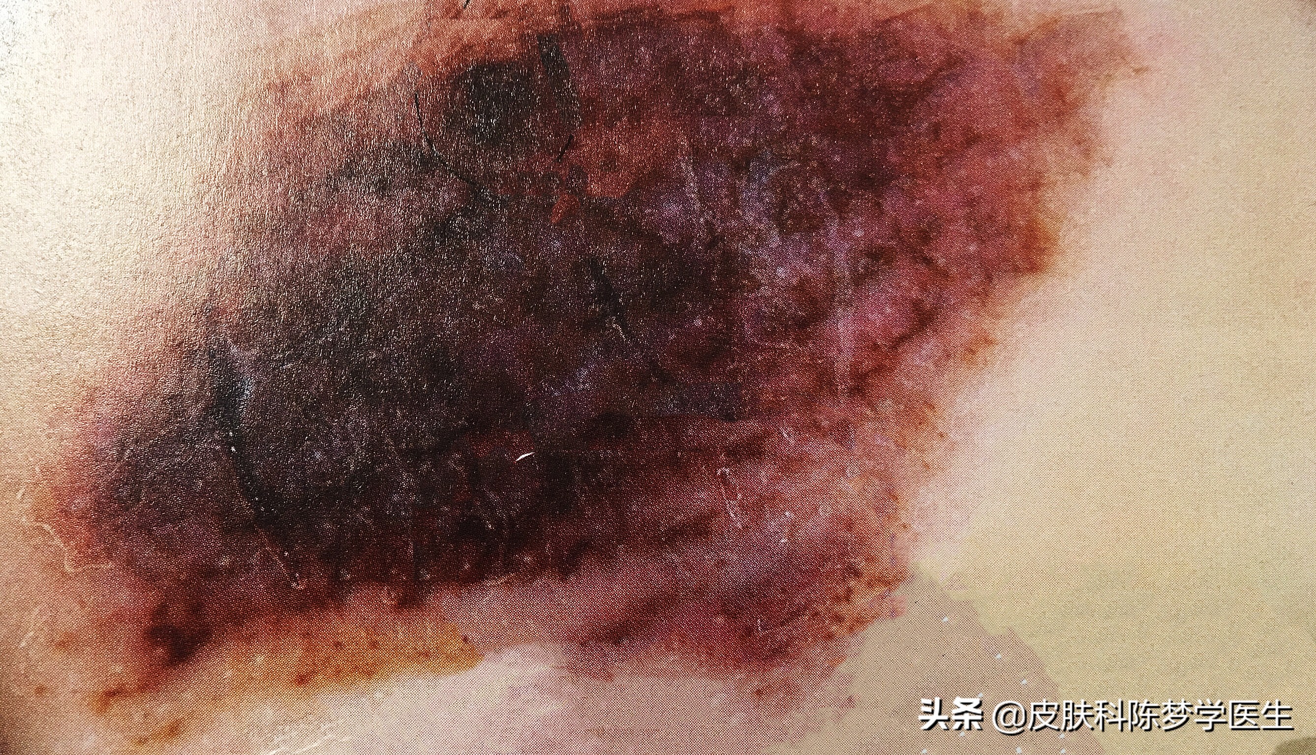 一次激光点痣会导致癌变吗,激光点痣会诱发痣癌变是真的吗