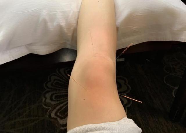 膝盖积水是怎么导致的,膝盖为何积水