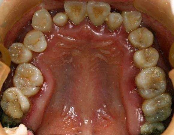 牙周炎牙疼的最佳治疗方法,牙周炎牙疼怎么治疗最有效好得快