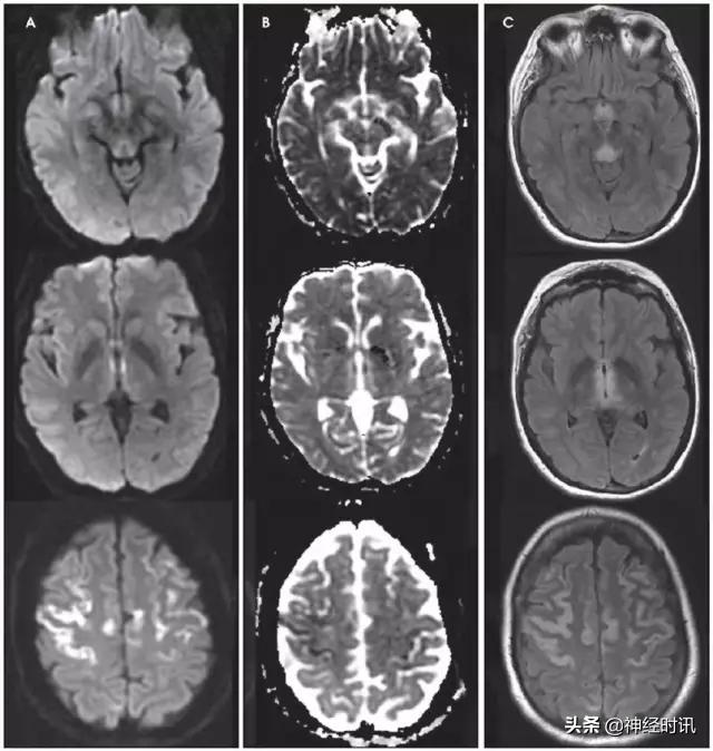 脑卒中病历诊断书图片,脑卒中影像判断技巧图解电子版
