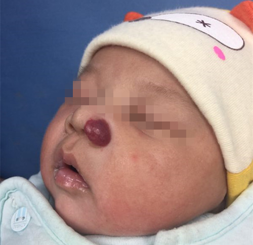 婴幼儿血管瘤长在头皮,婴儿血管瘤长在特殊部位