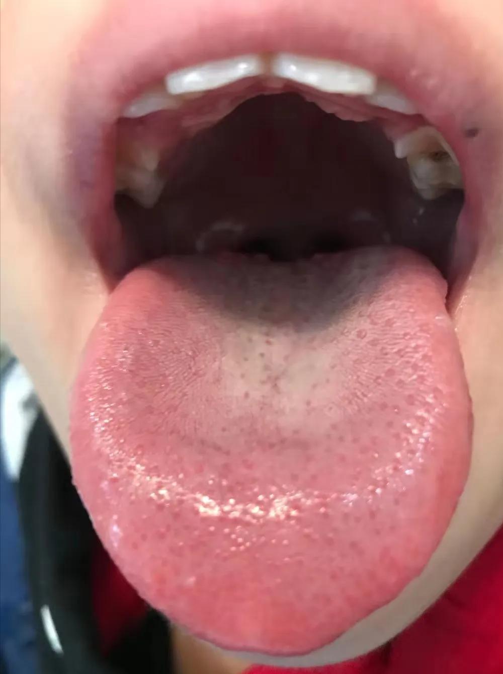 张景明治疗手足癣的中药方,一个治疗手足癣的好方子