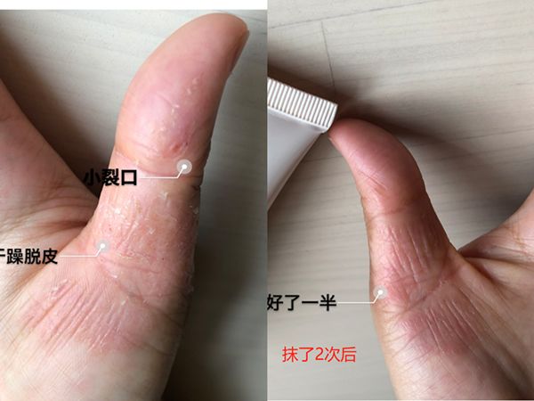 冬天脚跟干裂又起皮怎么办,冬天脚跟干裂起硬皮擦什么保湿好