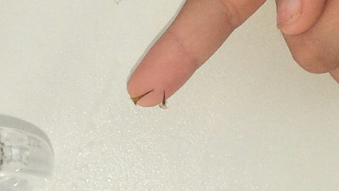 手指头扎刺怎么剔除？别再用针挑，教你一正确去刺不留痕小妙招，