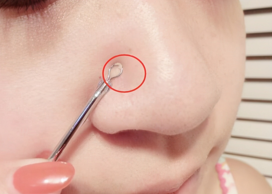 5分钟get到快速去掉黑头的小妙招,黑头比较严重祛黑头最有效的方法